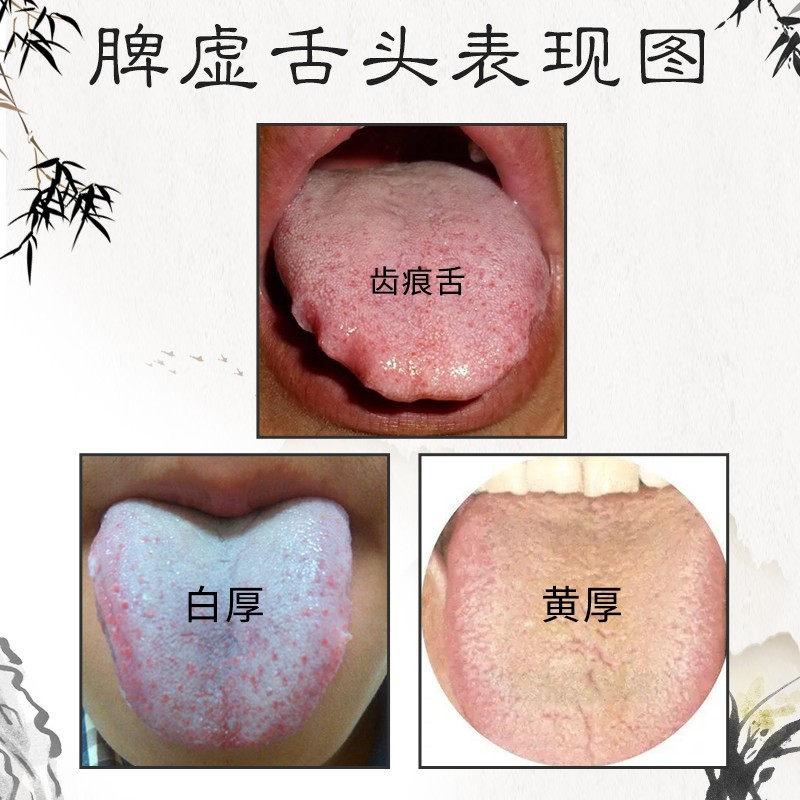 玖和健康培源人参茯苓舌苔白厚齿痕胖大舌口气臭舌苔黄腻脾虚湿气重胃调理