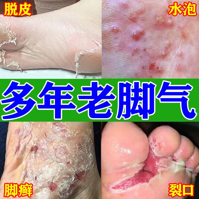 脚气药止痒脱皮烂脚丫真菌感染止痒 脚气膏治皮肤脱皮烂脚丫脚指缝