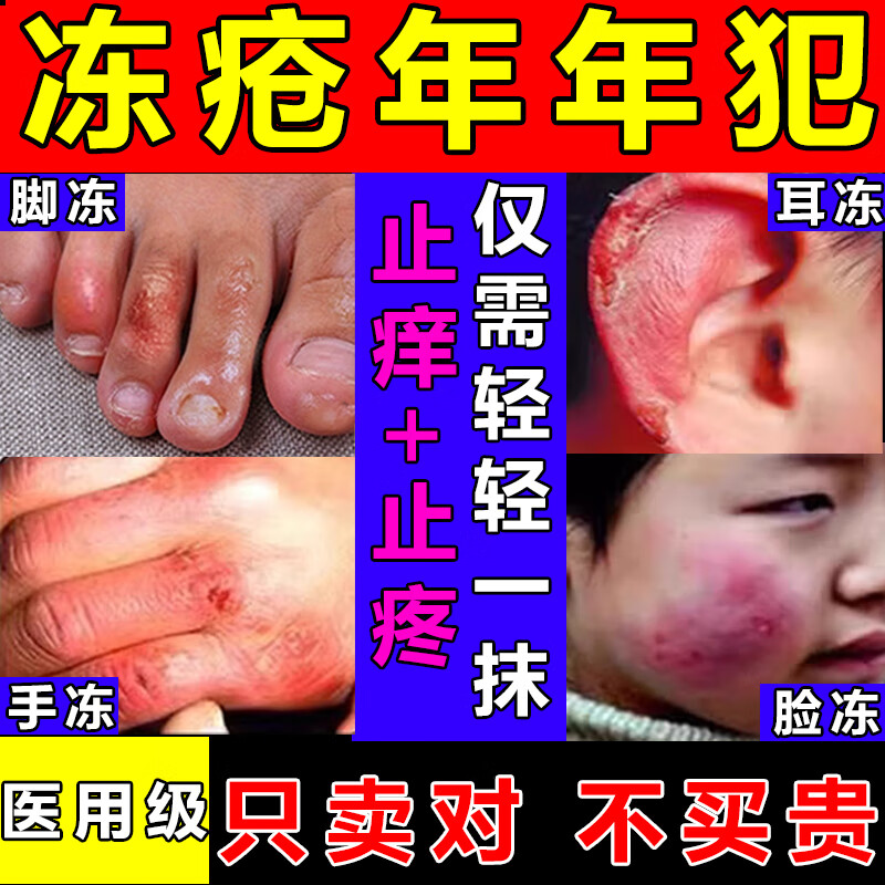 冻疮膏冻疮专用药 儿童成人耳朵脸部手指冻裂止痒 冻疮膏成人治药材根