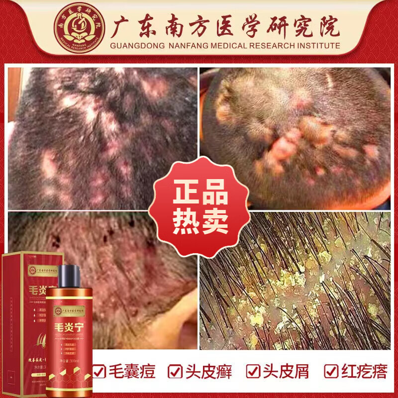 头皮毛囊i炎洗发水非药头部痒溢脂性皮炎头上长痘痘痒止去屑洗发水