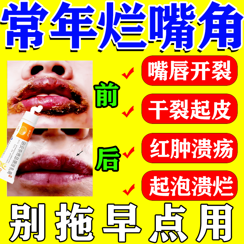 治嘴唇干裂脱皮药】嘴巴上火起泡烂嘴角起水泡唇炎专用药医用慢性唇炎