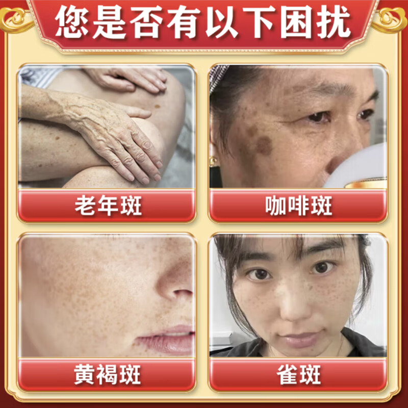 老年斑专用一夜消强力去除专用脸部手背祛斑霜专用强力去除沉淀祛 一盒