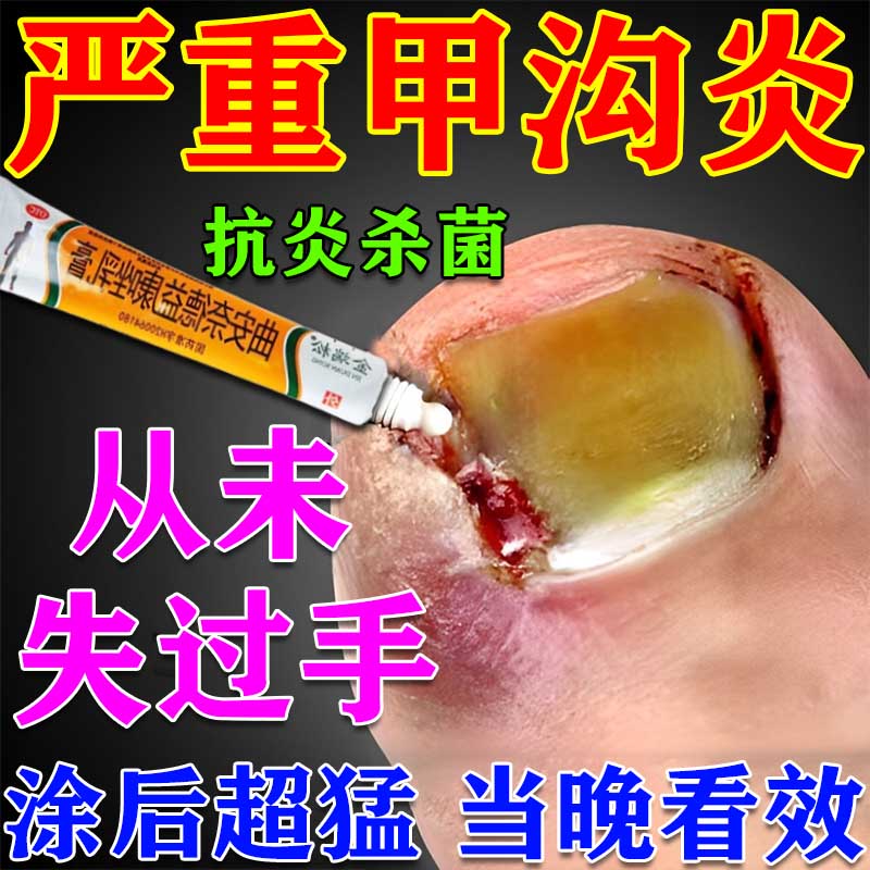甲沟炎消肿专用药 根i治甲沟炎嵌甲空甲去肉芽去除息肉化脓感染红肿