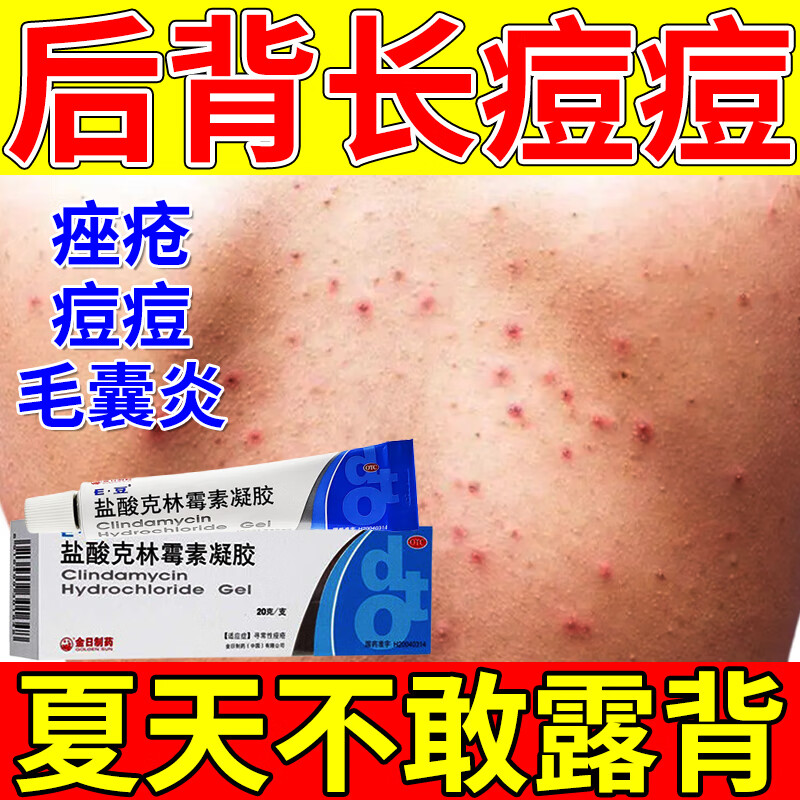 后背长痘痘痤疮闭口粉刺背上长满疙瘩额头长痘脸颊青春痘脓包盐酸克林