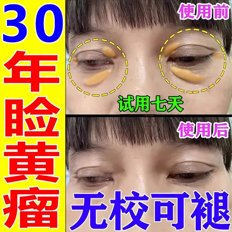 眼睑黄瘤去除眼角睑黄疣汗管瘤脂肪粒眼周白色黄色颗粒凸起不留疤 单