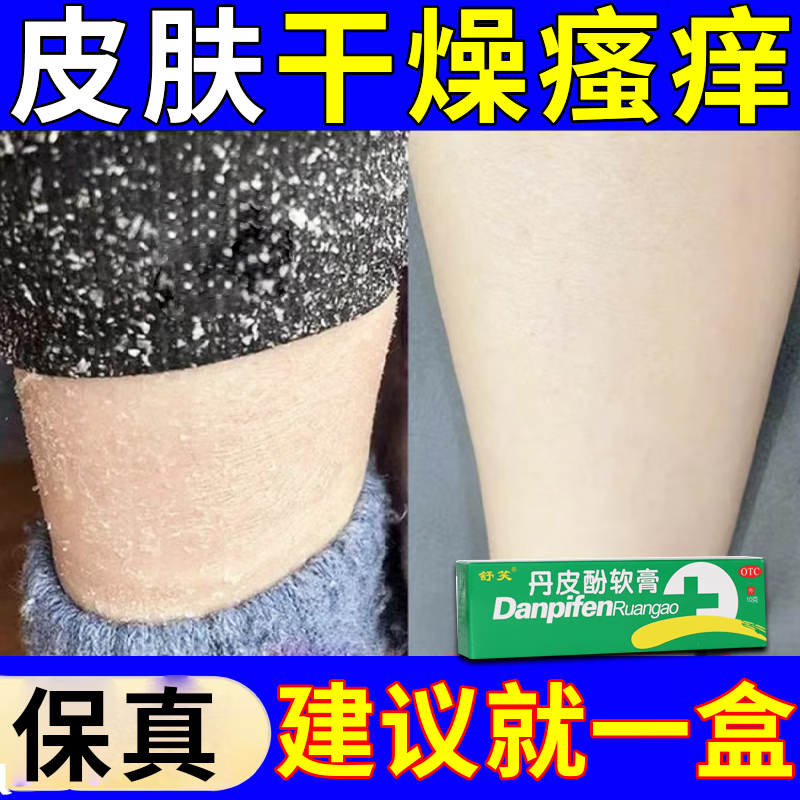 冬天皮肤干燥瘙痒皮肤瘙痒止痒膏药抑止痒菌皮肤瘙痒身体痒皮炎湿疹