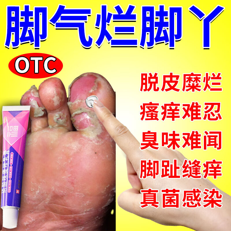 药】脚气膏止痒脱皮烂脚丫脚根气治真菌感染止痒水泡型脚气脚臭脚出汗