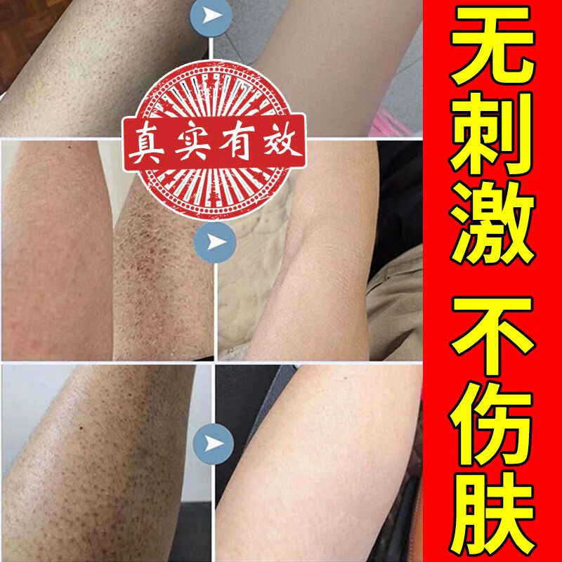 宮本武藏【正品】全身白美干皮雞皮保濕補(bǔ)水身體起皮干燥干癢滋潤(rùn)魚(yú)鱗男女 200ML假一賠十[國(guó)妝權(quán)威認(rèn)證] 1瓶裝[美白保濕/去雞皮魚(yú)鱗皮]