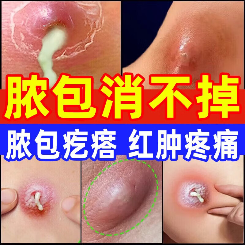 龙门 消炎片 脓包消炎治毒疖子屁股火疖子发炎硬块脓包疙瘩红肿瘙痒