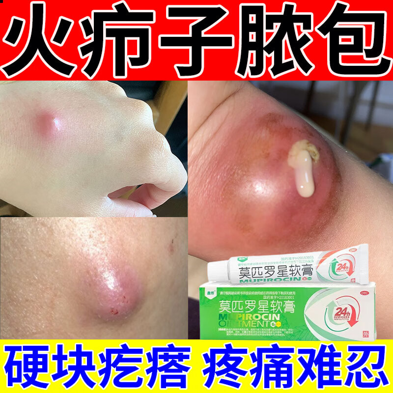 腺囊肿去皮下脸上痘痘脓包硬块红肿流脓疼痛毛囊发炎可搭拔毒专用药膏