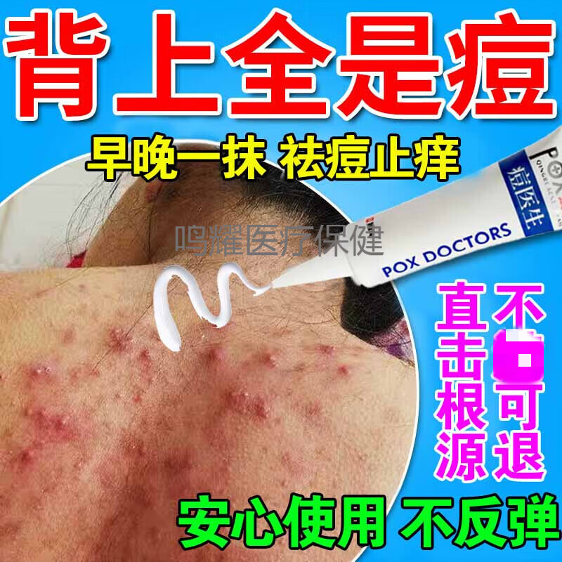 背上长痘痘药乳膏真菌男女背部止瘙痒脓包皮肤毛囊去i螨虫祛痘印修8