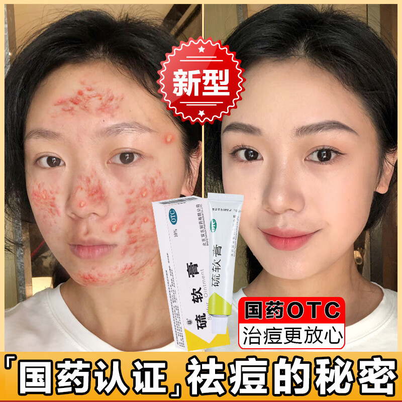 硫软膏脸上长痘痘专用otc药青春期祛痘印修复淡化痘印痘坑修复药膏去