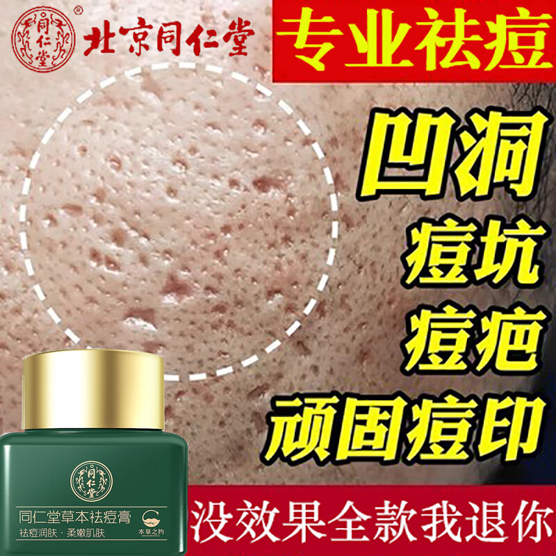 同仁堂祛痘膏去痘印修复淡化痘印痘坑20g