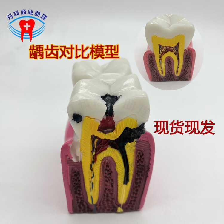 牙科口腔教学模型蛀牙龋坏发展演示水晶成人病理模型牙齿解剖展示 六