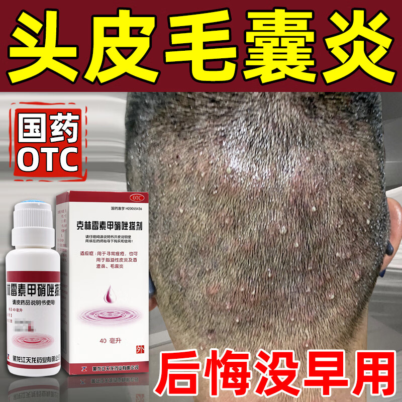 治毛囊炎头部专用药 头皮痒脂溢性皮炎头上长疙瘩脓包 后脑勺头皮毛囊