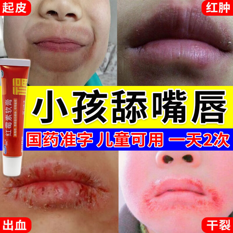 唇炎专用药儿童舔嘴唇】儿童嘴唇干裂脱皮羊胡子疮口角炎慢性唇炎上火