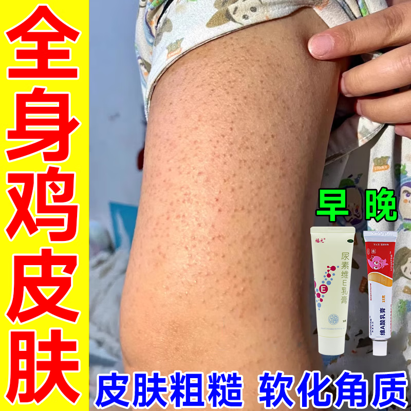 尿素维生素ie乳膏 维a酸乳膏 维e尿素乳霜 鸡皮肤疙瘩毛囊角化症用药