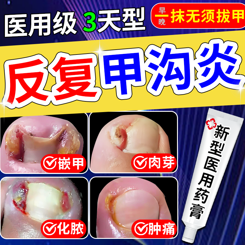 甲沟炎药膏足癣药 醋酸曲安奈德益康唑乳膏治疗甲沟炎消肿脚趾真菌