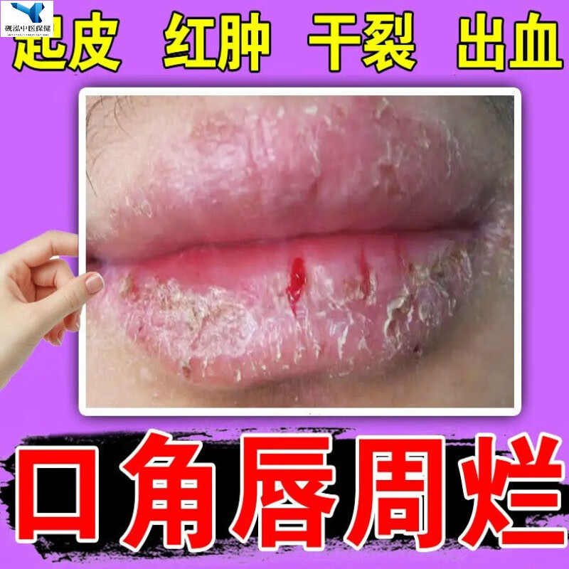 唇i炎防干裂专i用慢性唇i炎口角i炎i药修复嘴唇干裂脱皮起泡出血 单盒