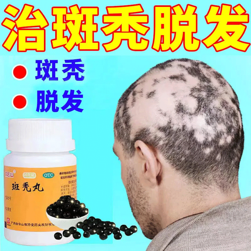 掉头发严重斑秃成片斑秃的药斑秃用什么药可选广盛原非北京同仁堂 1
