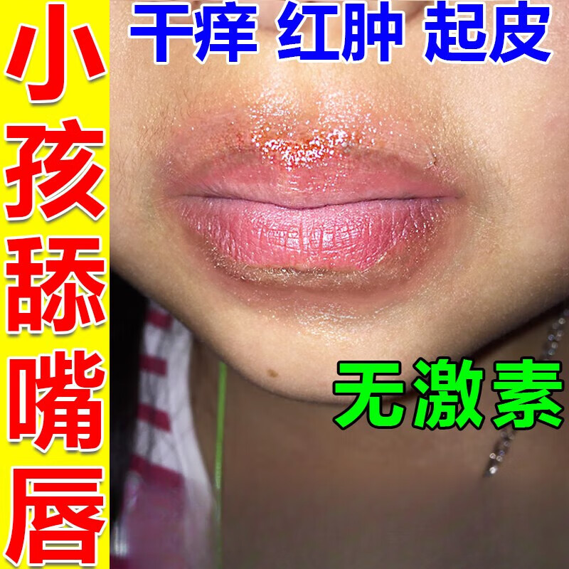 唇炎专用的药慢性唇炎儿童口角炎唇炎烂嘴角嘴唇干裂脱皮红肿灼热专用