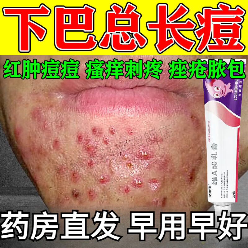 硬块闭口粉刺脸上长痘内分泌失调去下巴痘维a酸乳膏 1盒装轻微长痘痘