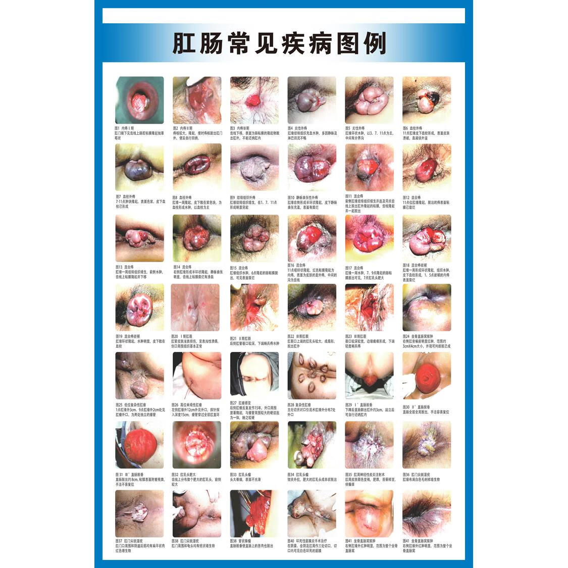 科茵格肛肠常见疾病图例墙贴纸肛肠科解剖图医院挂图广告宣传海报