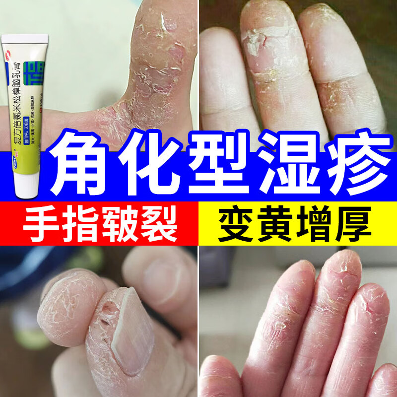 皲裂性湿疹药膏】手指干裂脱皮瘙痒手掌粗糙发黄变厚皮炎湿疹止痒药膏