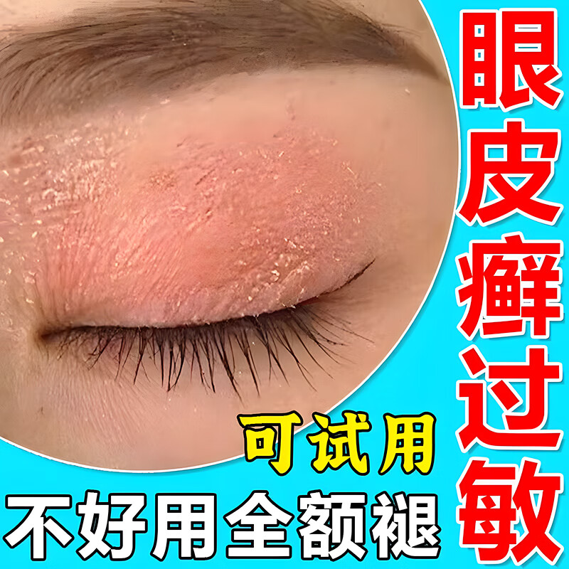 眼皮癣眼皮长癣眼睛周围眼角痒干燥起皮掉屑眼周过敏红肿脸起皮有碎屑