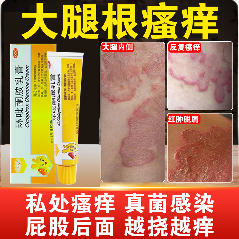 股癣膏大腿内侧股癣专科用药膏股藓大腿内侧 真菌感染环藓药皮肤癣藓