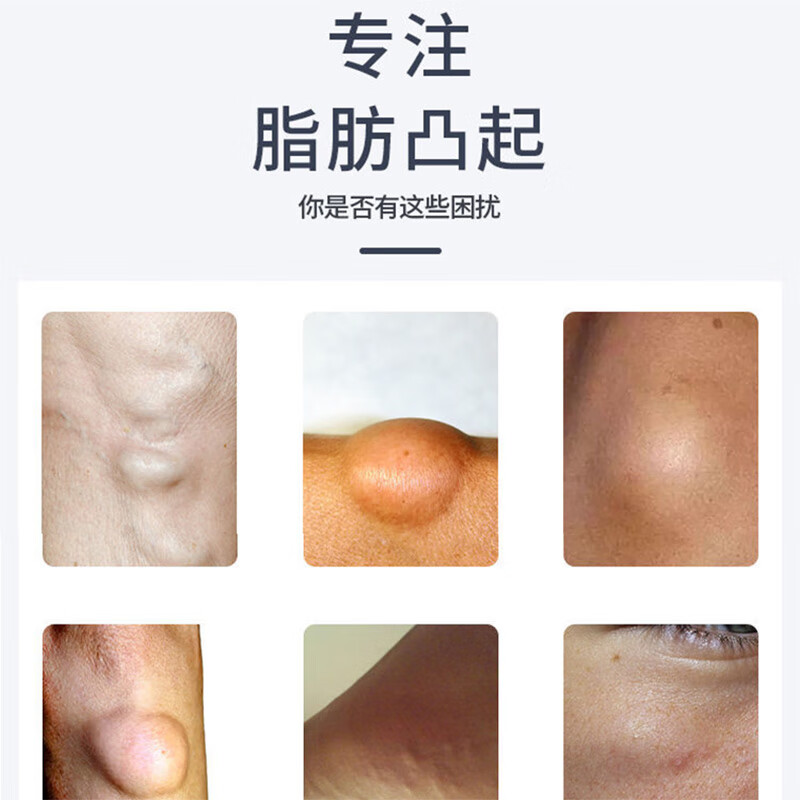 去除神器效特消瘤皮下粉瘤皮脂腺囊肿贴 单盒装  去脂肪瘤硬块肿胀