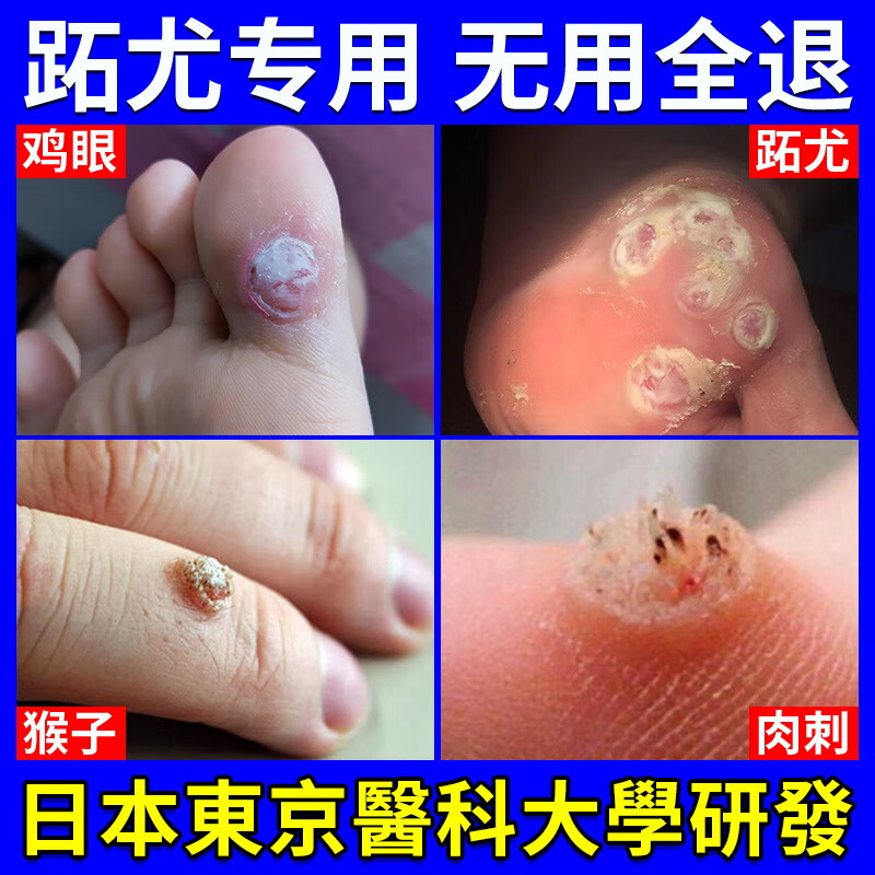 跖疣膏病毒拓趾足部根立净刺猴去除i瘊子肉粒疙瘩扁平疣鱼鳞痣疣去