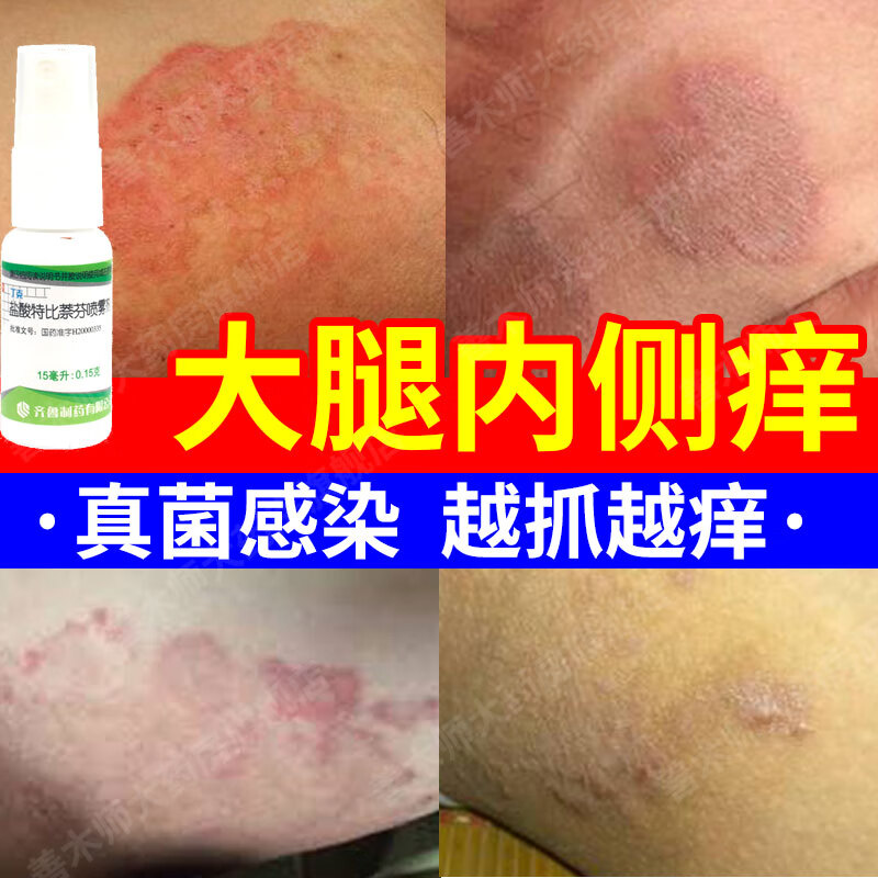 治疗股癣专用药股藓大腿内侧大腿根阴囊私处红疹瘙痒止痒喷雾喷剂体癣