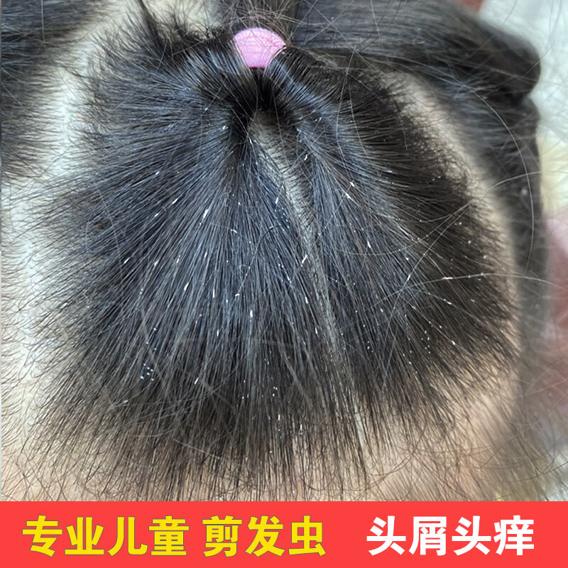 儿童痒去屑除i螨洗发水  剪发虫洗发水女孩专业去卷发虫吃发虫除i螨