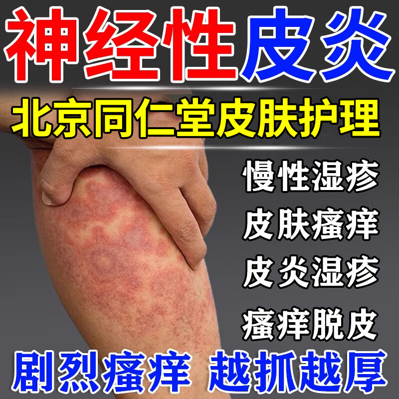 性皮炎专用顽固特傚非药溢脂性皮肤瘙痒湿疹真菌感染止痒红斑干燥脱屑