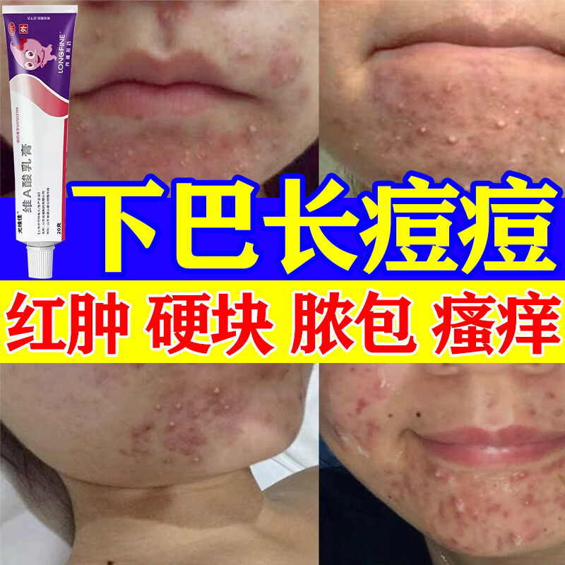 下巴长痘痘用什么药】下巴毛囊炎红肿硬痘痘闭口粉刺痤疮 淋巴痘硬痘