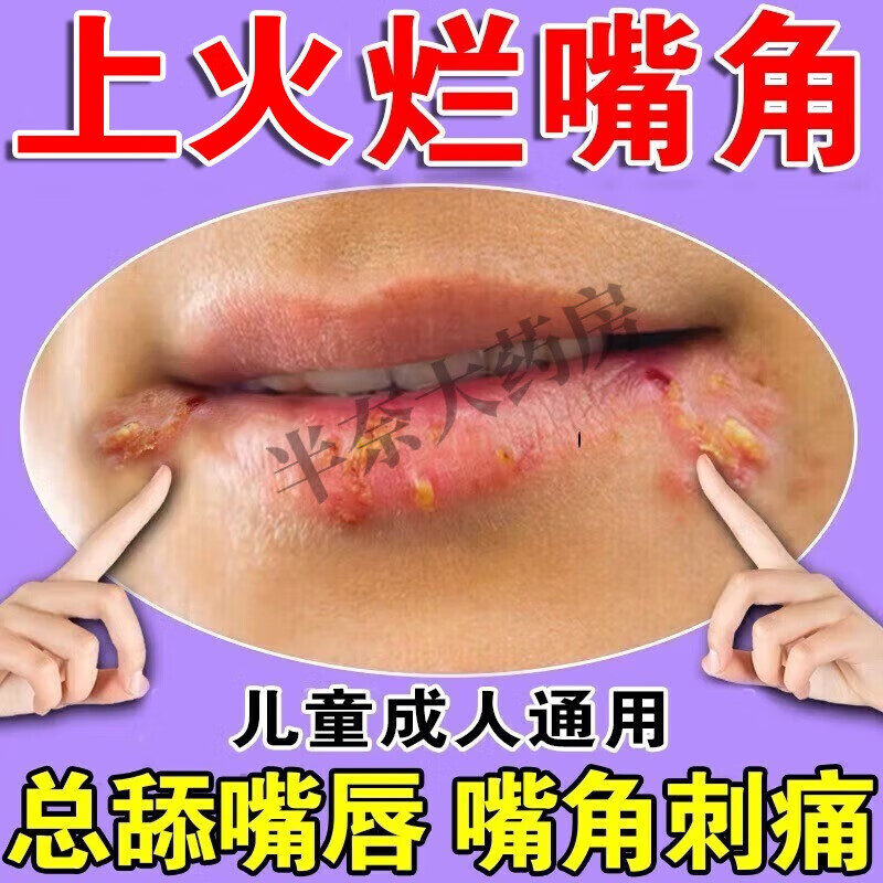 口角烂炎嘴角非药乳膏儿童唇炎烂嘴角干裂脱皮嘴角上火溃烂起泡真 单