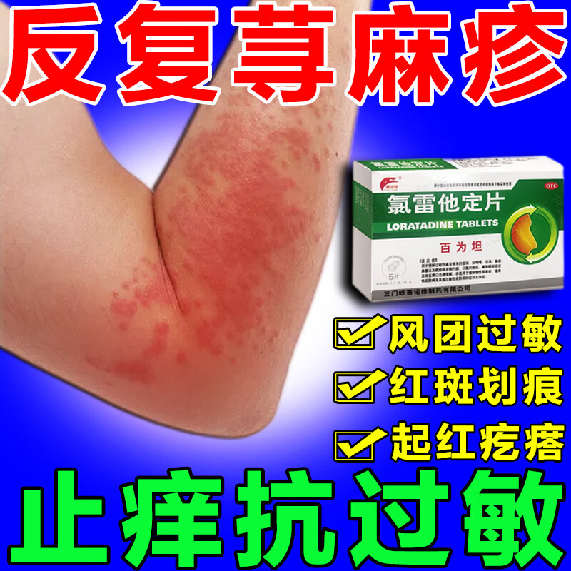 治皮肤过敏药皮肤瘙痒止痒药 慢性荨麻疹过敏药 身上痒痒用什么药