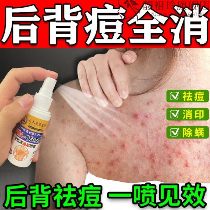 京藤花祛痘喷雾背后痘痘后背上长去除喷雾除螨虫背部胸前小疙瘩药 1瓶