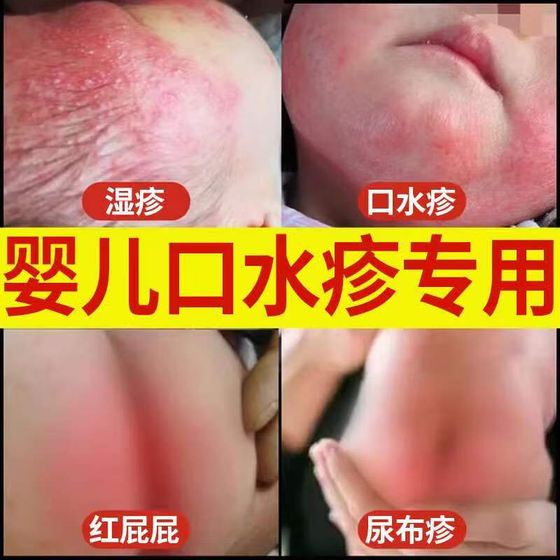口水疹膏婴儿无下巴发红奶癣瘙痒红肿干燥湿疹屁屁尿布疹db 1盒装宝宝