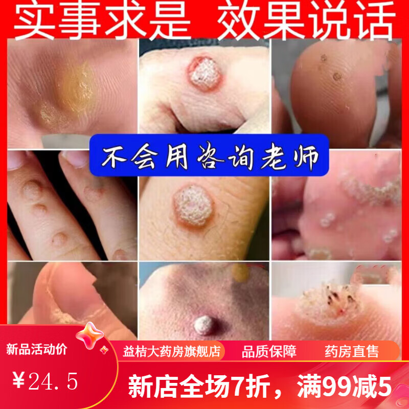 膏 去l根 去除跖疣专用膏瘊子寻常肉刺膏甲周疣小肉粒刺猴子去l疣灵