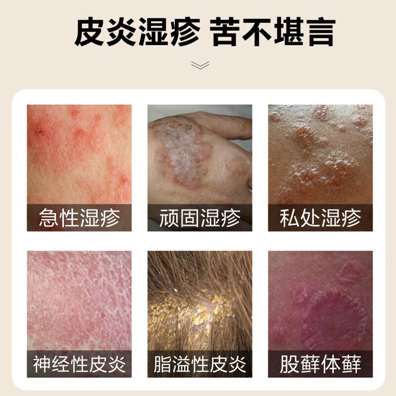 善维湿疹粉1小时强力止痒 顽固湿疹反复汗疱疹 私处肛周搔痒 无激素 湿疹粉1盒+保湿软膏
