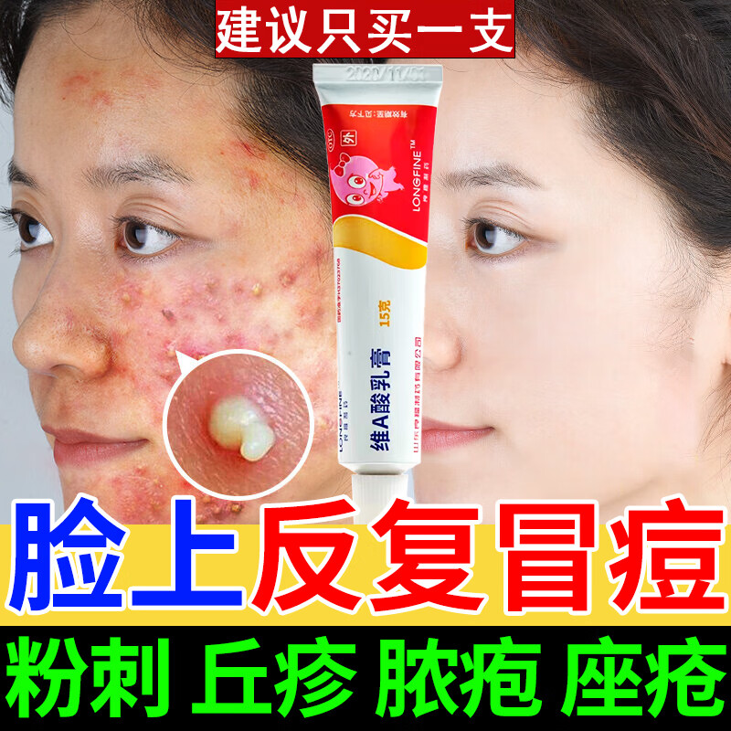 治疗脸上长颗粒痘痘的药 痤疮膏 脓疱疮去粉刺痘痘药膏 脸上长痘痘