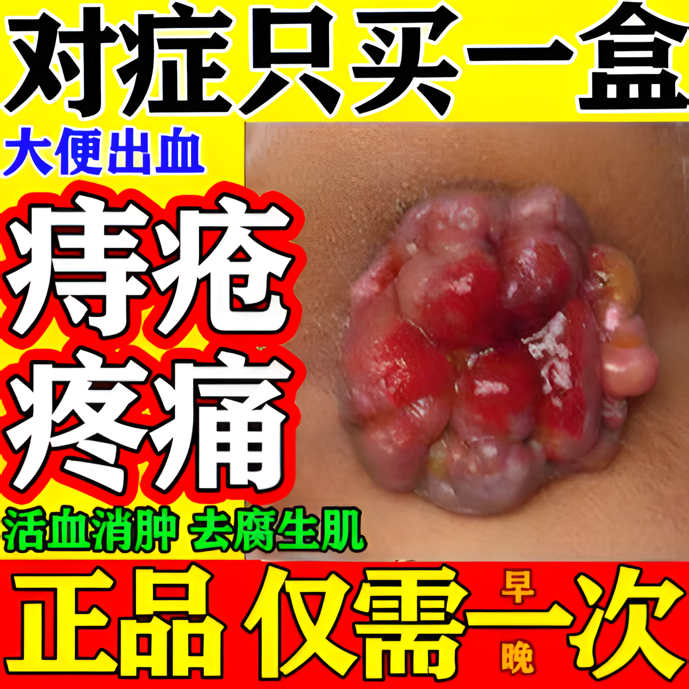 马应龙痔疮膏去肉球痔疮专用药内痔外痔混合痔肛门特瘙痒大便出血肿胀