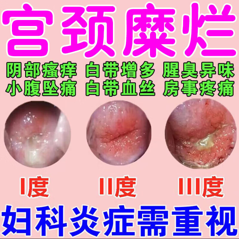 消糜栓 宫颈糜烂妇科专科用药滴虫性霉菌性阴道炎栓剂白带多腥臭色黄