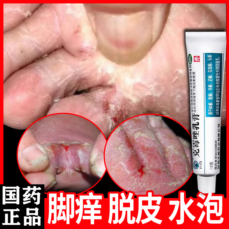烂脚丫药脱皮糜烂脚趾缝烂痒专用脚气otc药 足癣脚气的药膏 真菌感染
