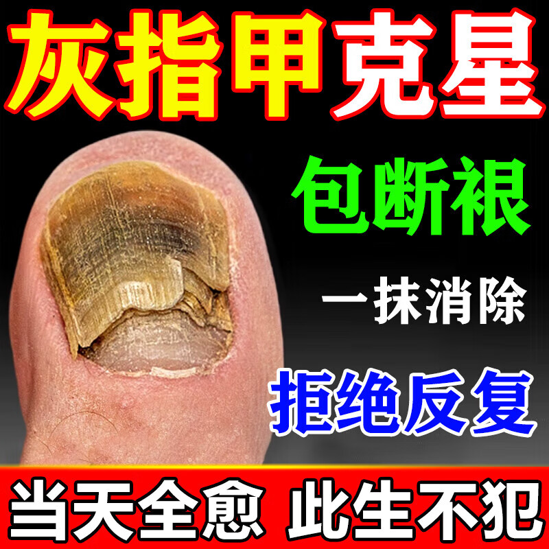 灰指甲特傚效药指甲真菌感染脱甲坏甲脚指甲增厚去除艮治抑菌正药 三