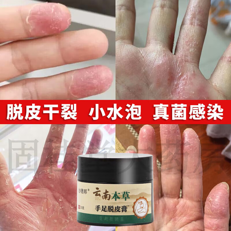 【药房直售】云南本草 手足脱皮膏可搭大人小孩手足部蜕皮小水泡真菌感染甲沟裂口手掌手指季节性脱皮 1盒装【轻度装】