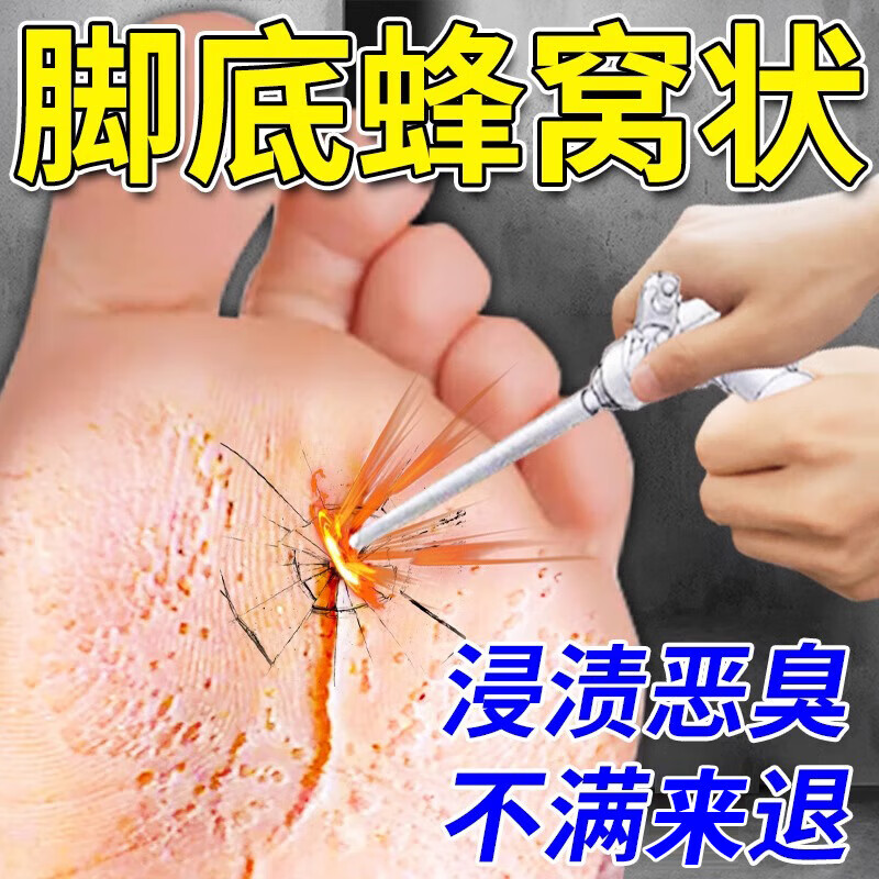 窝状角质松解症可搭药脚底发白糜烂臭蜂窝状沙虫骚痒脱皮烂脚丫泡脚