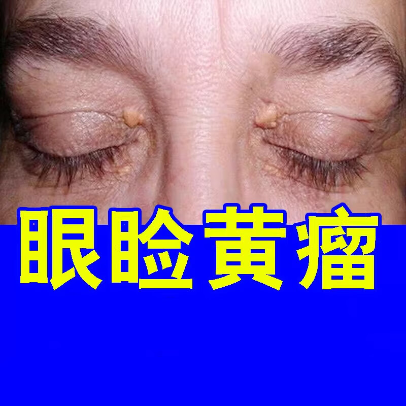 媗丝露兰肌美lanjimei草本克体疣膏睑黄疣膏眼脸黄瘤眼睑黄色瘤专用膏